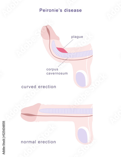 Medical chart of Peyronie's disease. Side view of human penis in normal erection and curved, demonstrating fibrous plague on its erectile tissue. photo