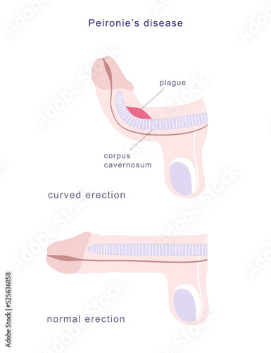Medical chart of Peyronie's disease. Side view of human penis in normal erection and curved, demonstrating fibrous plague on its erectile tissue.