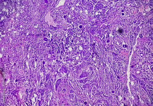 Spinal tumor biopsy showing Psammomatous meningioma. Psammoma bodies. photo