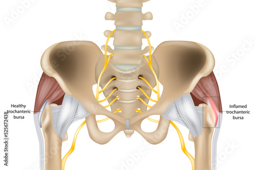Hip Trochanteric bursitis is inflammation of the bursa. Illustration of the Healthy and inflamed trochanteric bursa. Greater trochanteric pain syndrome. photo