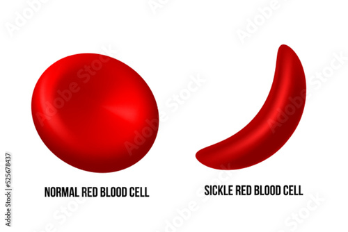 Sickle cell disease. The difference of Normal red blood cell and sickle cell.