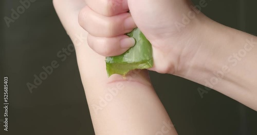Closeup blisters, Female Applying Aloe Vera on her Palm Moisturizing and Caring for her Skin. using Aloe Vera on treat fire burns in skin - heat burn wound on hand caused by hot cooking oil spill. 