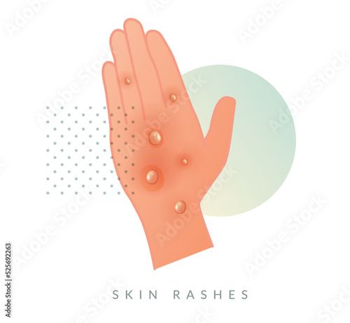 Monkeypox - Skin Rashes and Spots as Symptoms - Icon