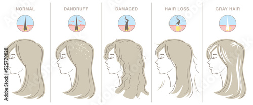 Types of women's hair problems. Profile of young woman, and hair cross section icon. Normal, dandruff, damaged, hair loss, gray hair. Vector illustration isolated on white background.