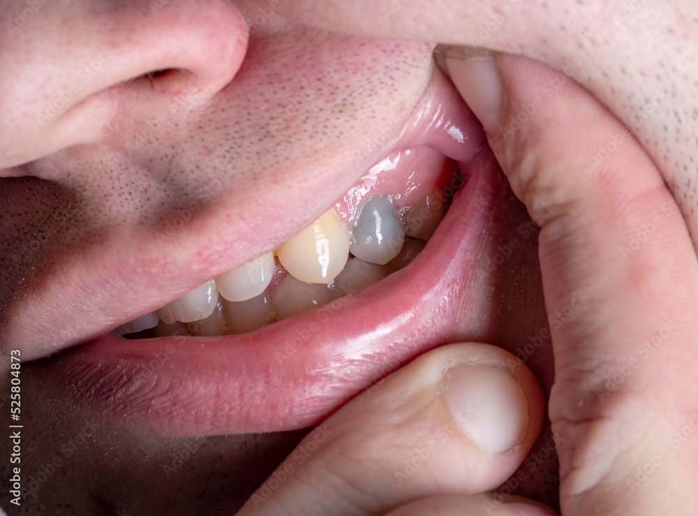 Obraz premium A dark tooth in a man's mouth after injury. Tooth decay by caries, dentistry. Macro