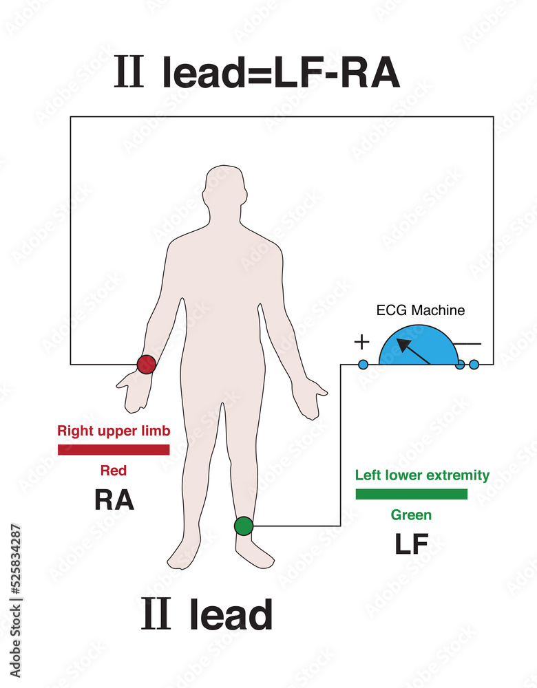 The positive electrode of lead Ⅱ of the ECG is placed on the left lower
