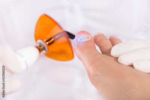 Рodologist (podiatrist) in gloves puts a titanium thread on a toenail with special polymerization ultraviolet lamp. Close-up. Podology and chiropody concept.