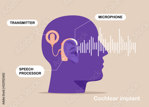Cochlear implant device electrically stimulates nerve medical aid ear sound wave adults hard middle exam. Vector illustration.
 photo
