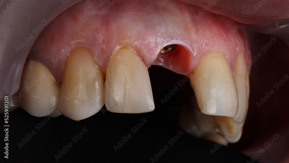 composition of the installed dental implant in the area of the central tooth without a crown, side view