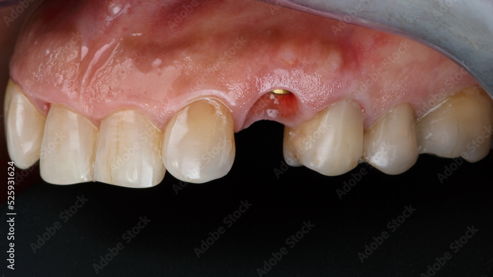 composition of the upper jaw before placing one crown on the implant