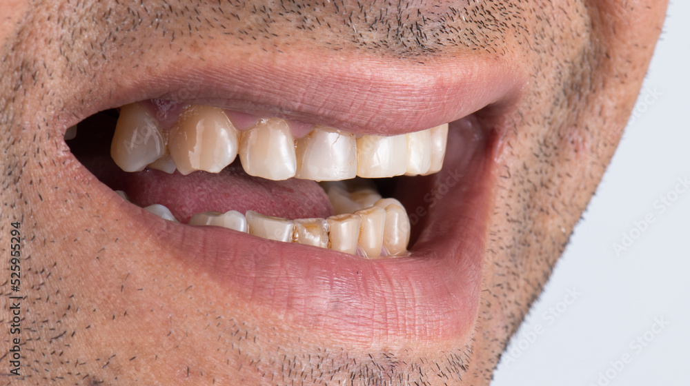 Obraz premium dental job photography, crowns veneers implants