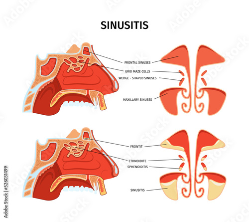 Sinusitis Infographics Illustration