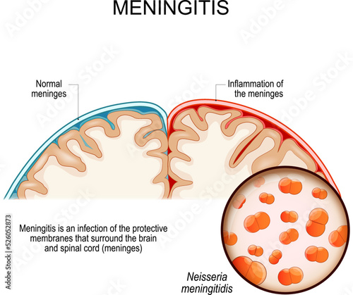 Meningitis. brain with Normal meninges and Inflammation of the meninges.  photo