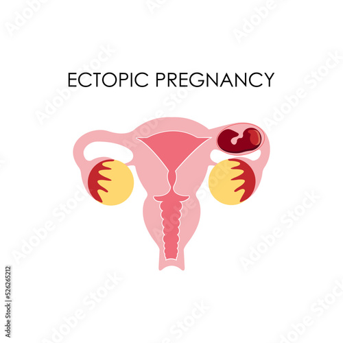 Anatomical drawing. Ectopic pregnancy. The female uterus.