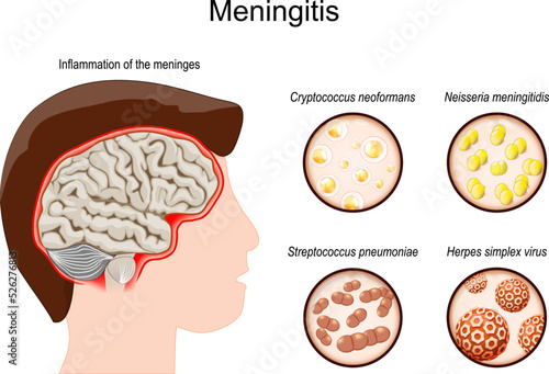 Meningitis. Human's brain with Inflammation of the meninges and Pathogens