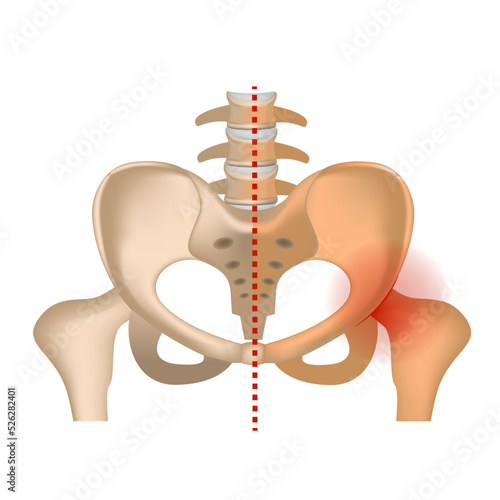 aseptic necrosis. Hip bone with damaged femoral head. Infographic with axis of symmetry. Vector illustration photo