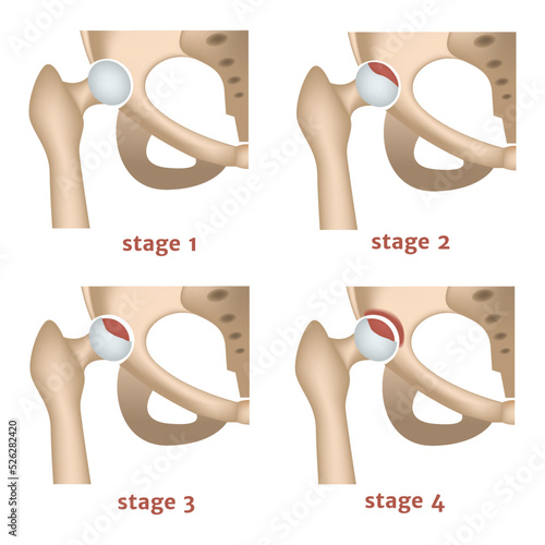 aseptic necrosis. Stages of destruction of the femoral head. Medical poster. Vector illustration