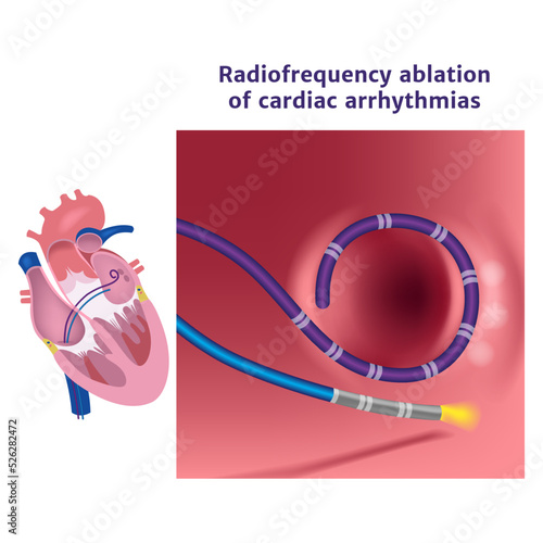 Radiofrequency catheter ablation of the heart. Illustration with a surgical procedure. Medical poster. Vector illustration
