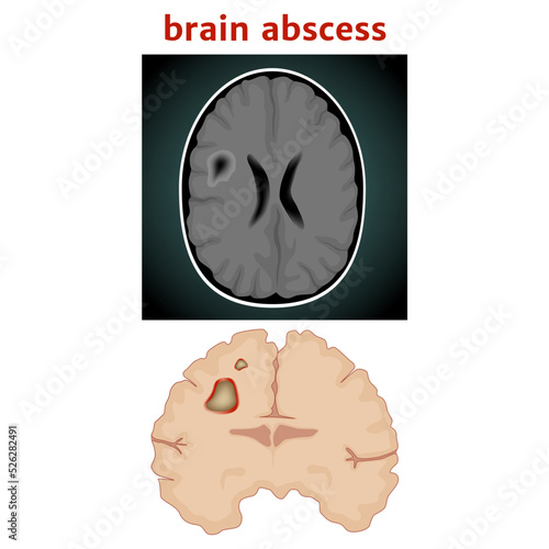 brain abscess. limited purulent fusion of the substance. Medical poster. Vector illustration