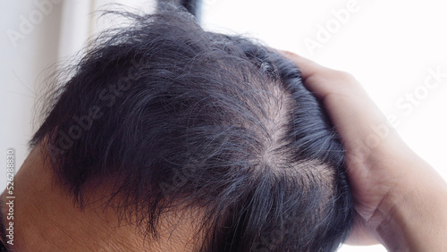 Young Asian man using his hand slicking his hair back after facing hair loss problem by taking medicine like zinc and biotin to make his hair grow faster and thicker. Men health and medical concept