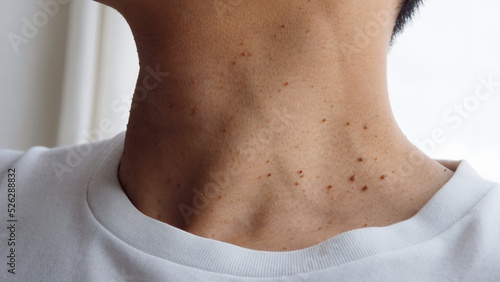 Many skin tags or Acrochordon on the neck They are small soft and common benign on the human skin especially on adult skin and can be irritated by shaving and daily clothing