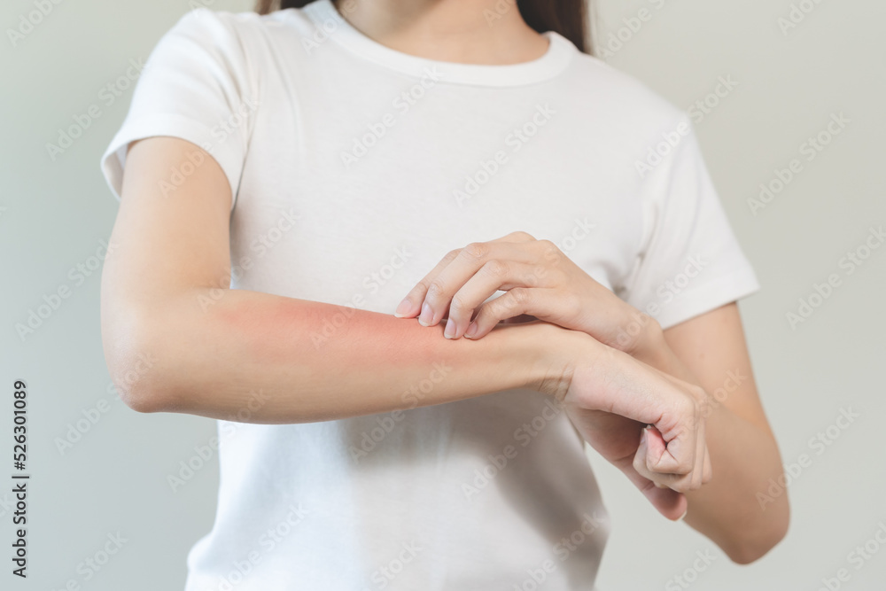 person have red rash on arm from insect bite allergic.