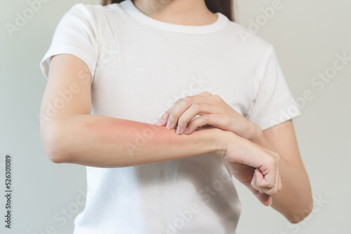 person have red rash on arm from insect bite allergic.