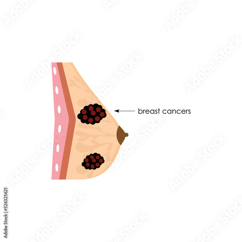 Anatomical drawing. Female breast with cancer.