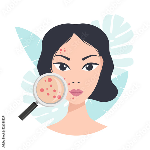 Acne skin problems. Woman holding magnifying glass for looking cystic acne on her facial. Vector illustration about skin problem concept