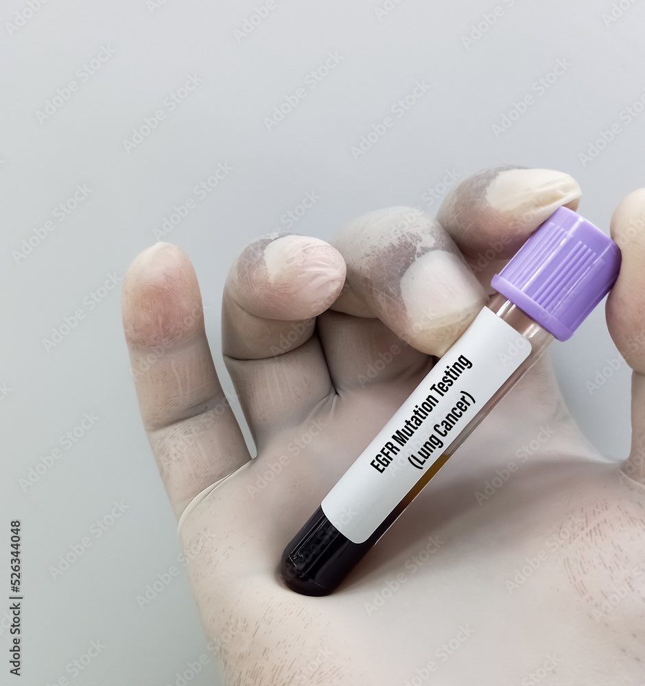 Molecular biologist holding blood sample for EGFR mutation test for the