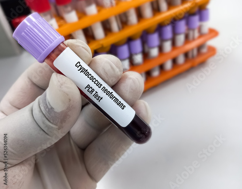 Scientist holding blood sample for Cryptococcus neoformans PCR test.