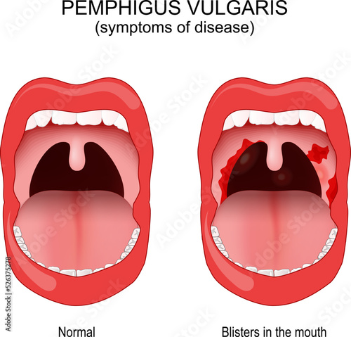 Pemphigus vulgaris. Early symptoms inside the mouth