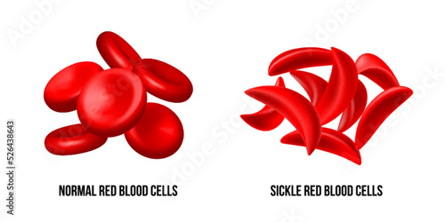 Sickle cell disease. The difference of Normal red blood cell and sickle cell.