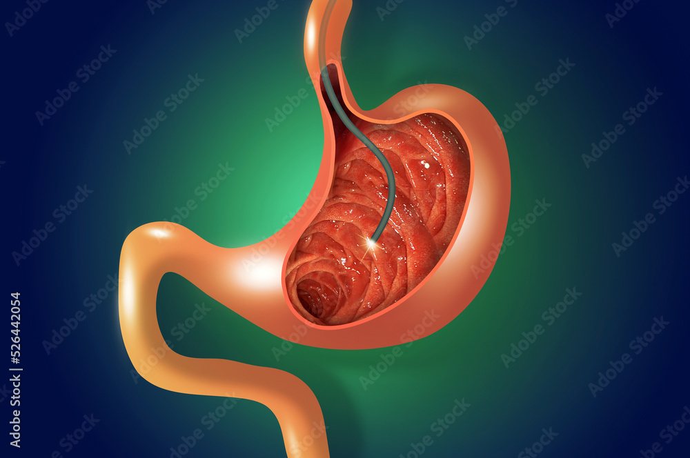 Digestive endoscopy or gastroscopy. Performing a gastroscopy procedure. Diagnostics of gastric diseases. Stomach health. Medical concept