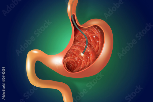 Obraz na płótnie Digestive endoscopy or gastroscopy. Performing a gastroscopy procedure. Diagnostics of gastric diseases. Stomach health. Medical concept w salonie