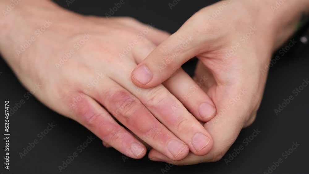 Man with burn on her hand, closeup. Burn blister on the hand. Hand male with blisters due to burns Man with burn on her hand, closeup. Burn blister on the hand. Hand male with blisters due to burns