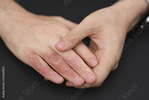 Man with burn on her hand, closeup. Burn blister on the hand. Hand male with blisters due to burns