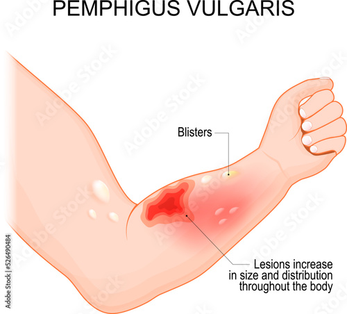 Pemphigus vulgaris. Arm with Blisters