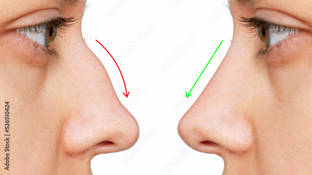 A profile of woman's face with nose before and after rhinoplasty isolated on white background. Comparison after cosmetic plastic surgery on the hump of the female nose. Correction of the nasal septum - obrazy, fototapety, plakaty 