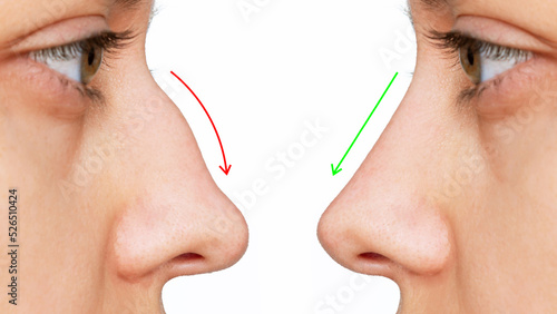 A profile of woman's face with nose before and after rhinoplasty isolated on white background. Comparison after cosmetic plastic surgery on the hump of the female nose. Correction of the nasal septum photo