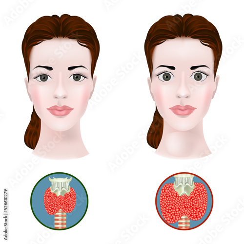 Autoimmune therioditis. Enlargement of the thyroid gland and protrusion of the eyes. Disease infographic. Medical poster. Vector illustration