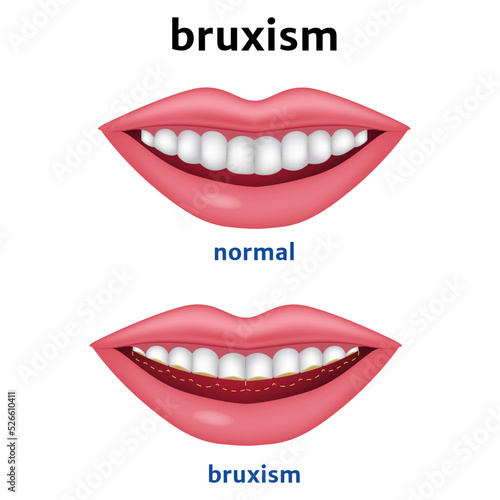 Bruxism. Diagram with worn teeth. Vector illustration