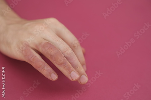 Man with burn on her hand, closeup. Burn blister on the hand. Hand male with blisters due to burns
