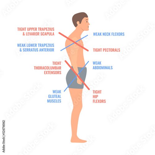 Upper and lower crossed syndrome medical diagram. Crooked man with muscle strength imbalance. Weak and overactive muscles therapy. Incorrect spine curvature caused by bad posture. Vector illustration.