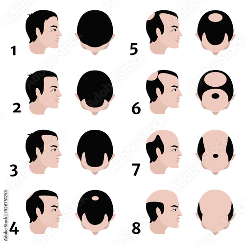 Stages of baldness according to the Norwood scale. Vector flat illustration photo