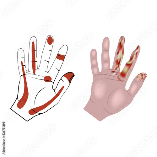 Pyoinflammatory processes of hands and fingers. Infographic with affected areas. Vector illustration