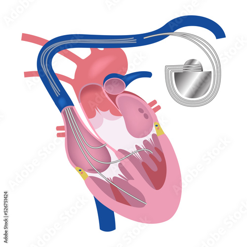 Pacemaker. Heart in longitudinal section. Vector medical illustration