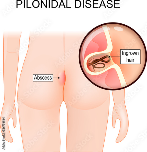 Pilonidal disease. skin infection. Close-up of a cyst with Ingrown hair