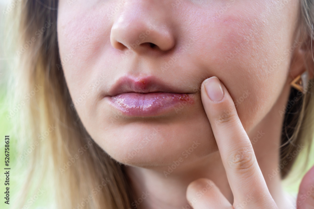 Obraz premium Herpes on the lips of young woman. Close up