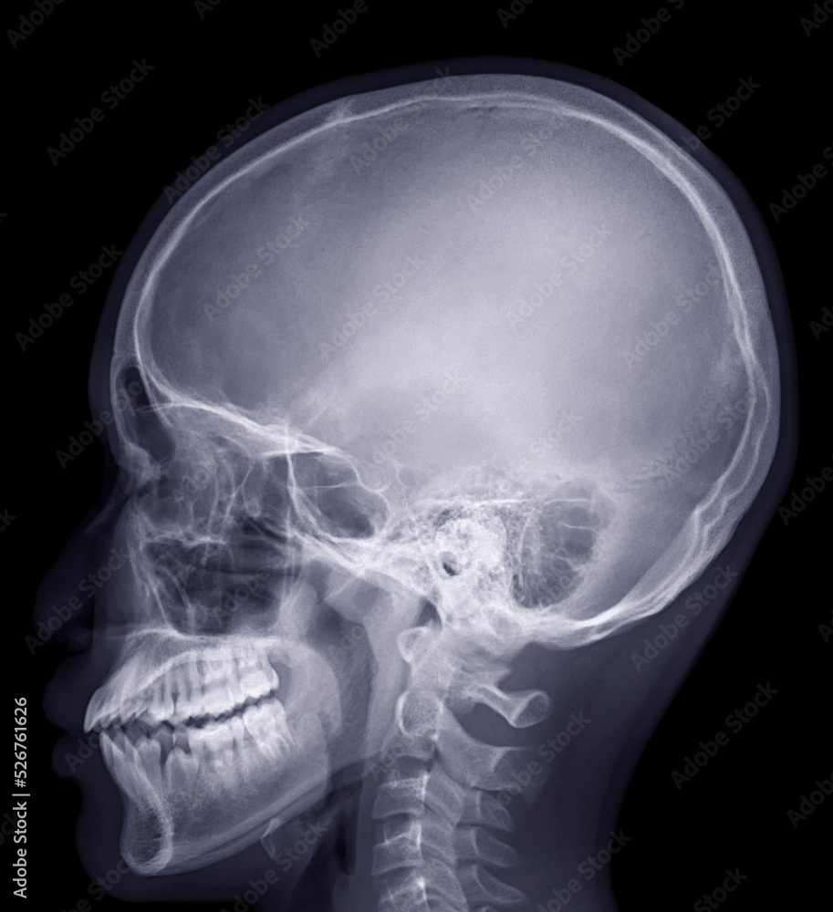 Skull xray image of Human name is skull lateral view isolated on Black